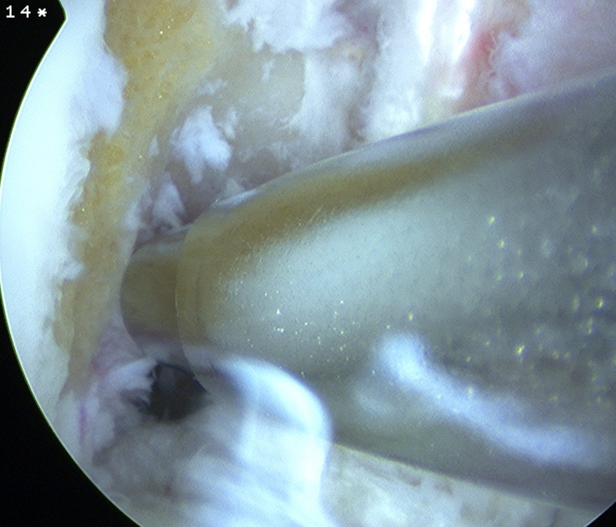 ACL Clear Lateral Wall